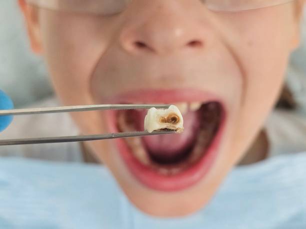 Best Emergency Wisdom Tooth Extraction in Shullsburg, WI